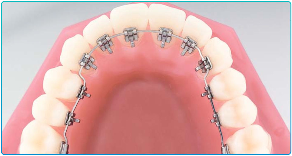 Лингвальные брекеты в Химках